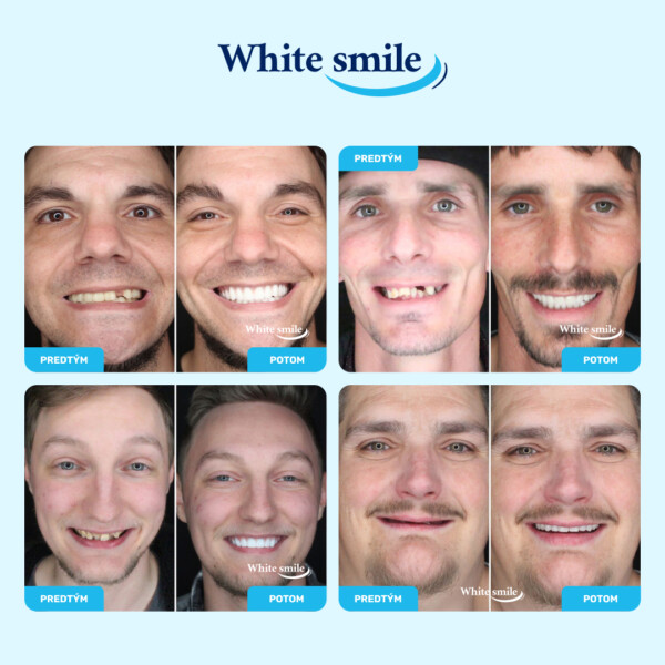 Realisticky vyzerajúce falošné zuby: WhiteSmile - Image 3